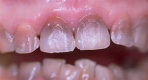 Dent tetraciclina, Kit Dental