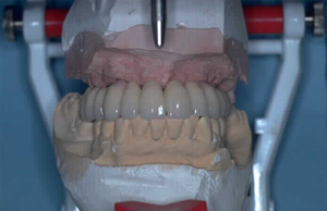 Arcada superior sobre implants, Kit Dental