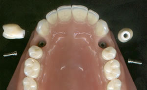 Zircòni directa a implant, Kit Dental